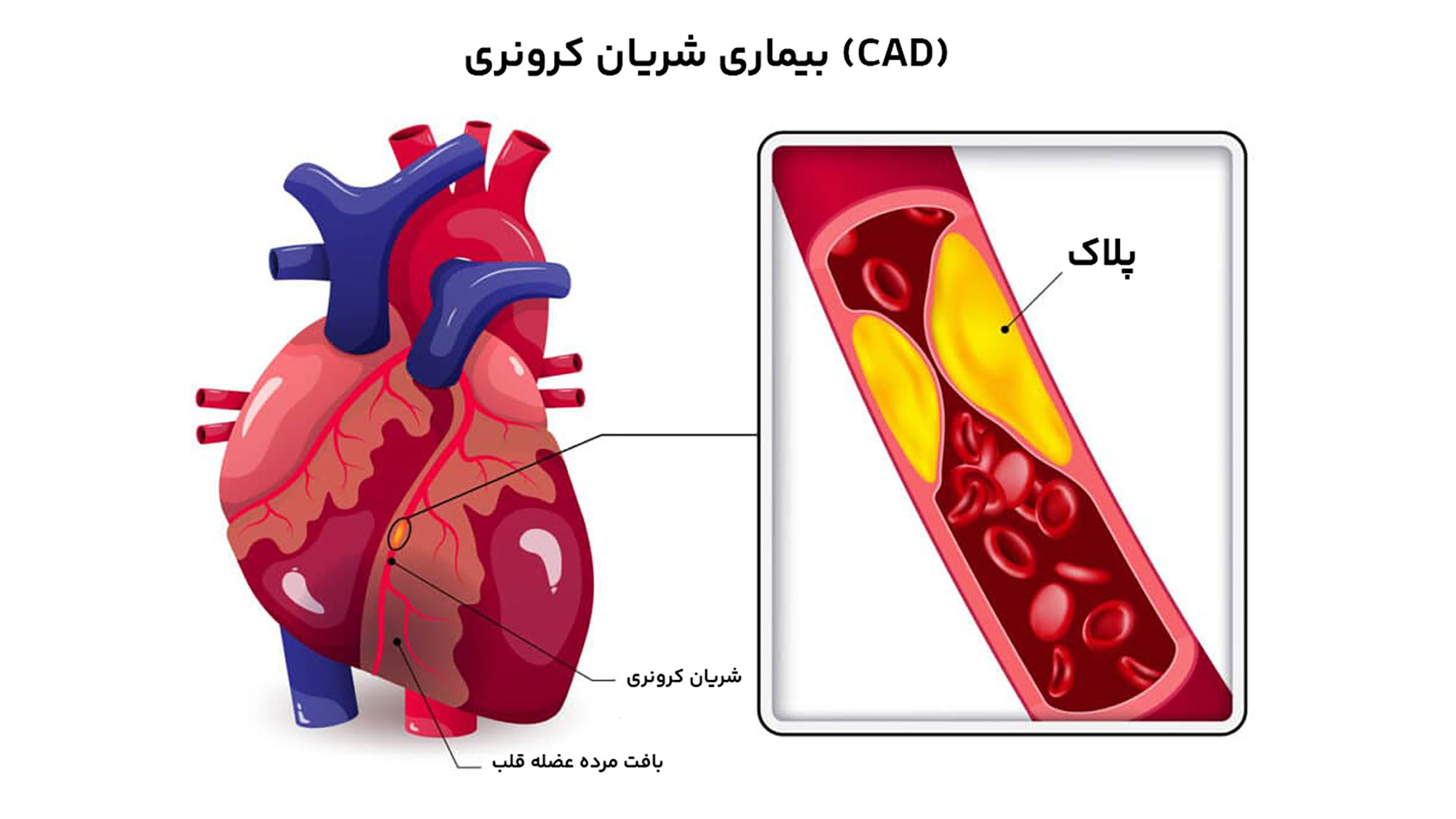 عروق کرونر با رسوبات کلسیم